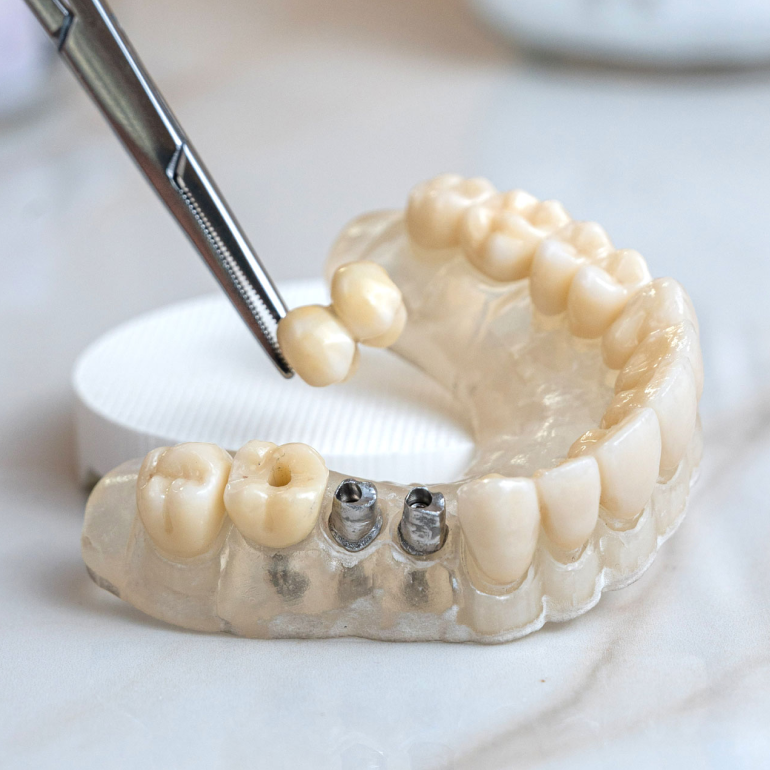 implantes_aragonesescpd